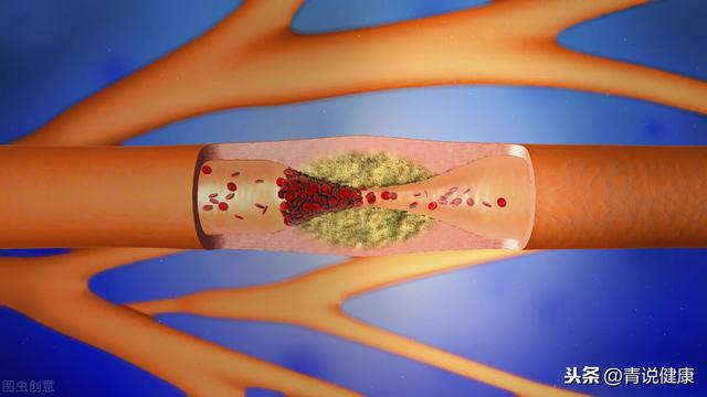 血栓和斑块有什么区别？纳豆激酶可以起到什么作用？